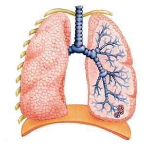 Χρόνια αποφρακτική πνευμονοπάθεια - απειλή για τη ζωή των καπνιστών